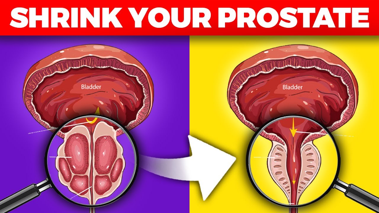 Wake Up to a Smaller Prostate: The Overnight Method Doctors Swear By!